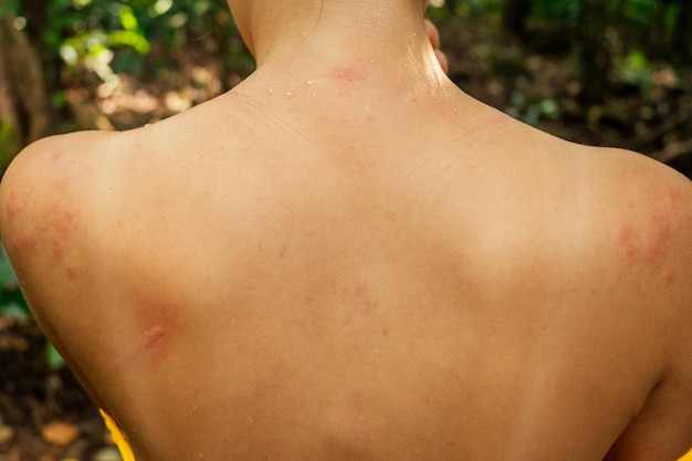 Mujer con picazón por picadura de insecto en el cuerpo en el bosque tropical de la selva