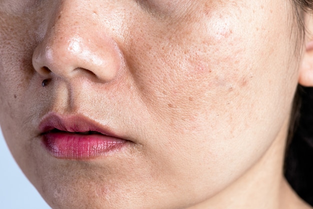 Mujer con piel problemática, cicatrices de acné, arrugas y manchas oscuras.