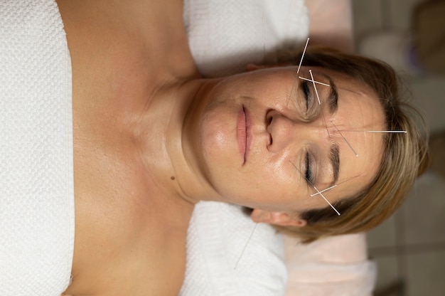 Foto mujer en el salón con terapia de acupuntura