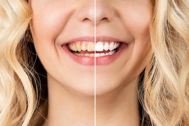 Mujer sonriente antes y después del procedimiento de blanqueamiento dental imagen de primer plano