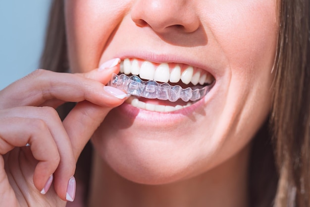 Mujer con sonrisa perfecta usando alineadores dentales invisibles para corrección dental