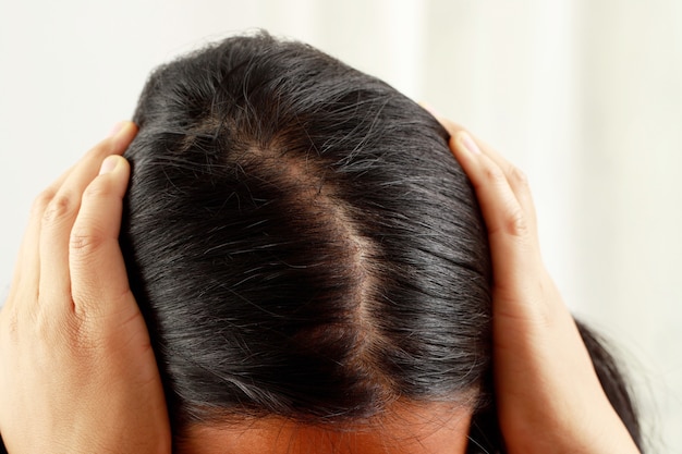 Una mujer tiene mucha pérdida de cabello, tiene un problema con su cabello y cuero cabelludo.