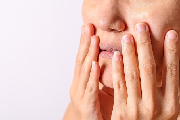 Las mujeres alérgicas tienen eczema nariz seca y labios en primer plano de la temporada de invierno.