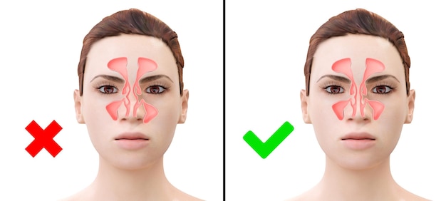 Mulher antes e depois da correção do desvio do septo nasal. ilustração 3d