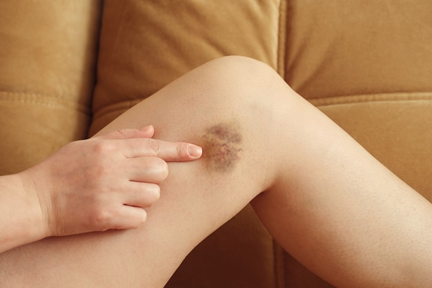 Foto mulher aponta para um hematoma na perna contra o sofá.