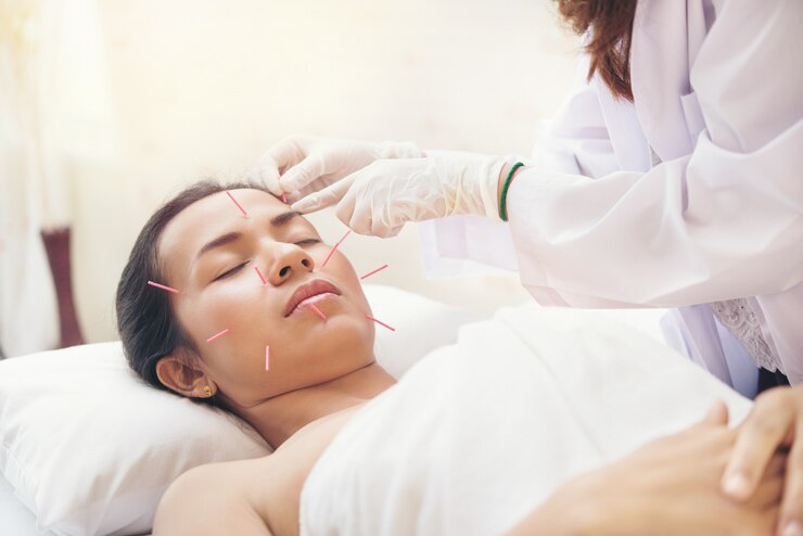 Mulher asiática nova relaxada que recebe o tratamento da acupuntura no spa da beleza