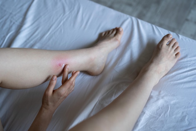 Mulher asiática toca sua perna depois de ser picada por mosquito em casa sofrendo de reação alérgica