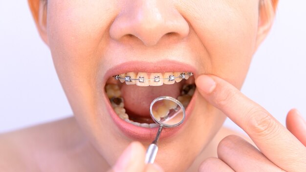 Mulher asiática usando contêiner ortodôntico. Atendimento odontológico e dentes saudáveis.