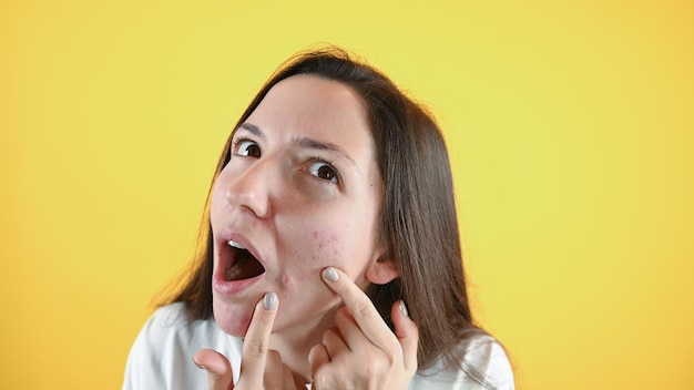 Mulher chocada mostra uma grande espinha no rosto de perto isolada na parede amarela Conceito de pele problemática Foto de alta qualidade