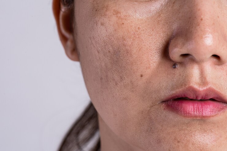 Foto mulher com pele problemã¡tica e cicatrizes de acne. conceito de skincare de problema.