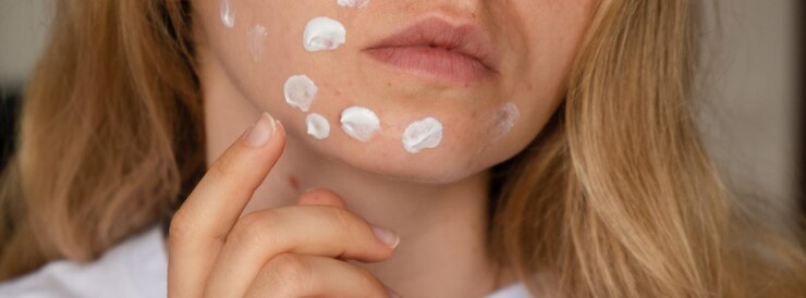 Foto mulher irreconhecível aplica creme de maquiagem sérum cura para a acne no rosto bandeira close-up acne em