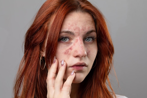 Foto mulher jovem com erupção cutânea aguda no rosto problemas dermatológicos devido a hipersensibilidade alérgica ou choque anafilático pele vermelha com erupção cutânea ou eczema