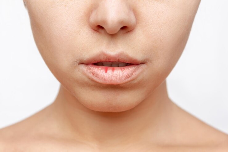Foto mulher jovem com lábios rachados secos de gelo ou deficiência de vitamina. lábios escamosos e desgastados
