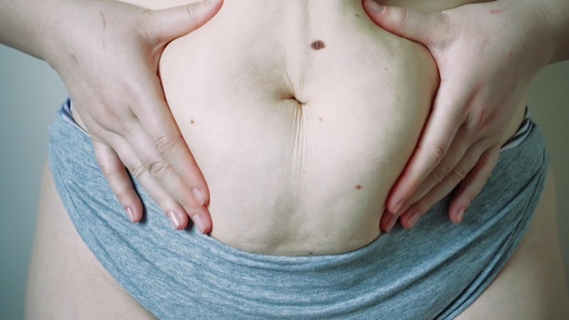 Mulher jovem com sobrepeso ou tamanho grande com cirurgia de barriga grande e conceito de divisão de gordura xl tamanho pessoas vida gordura e conceito de gordura