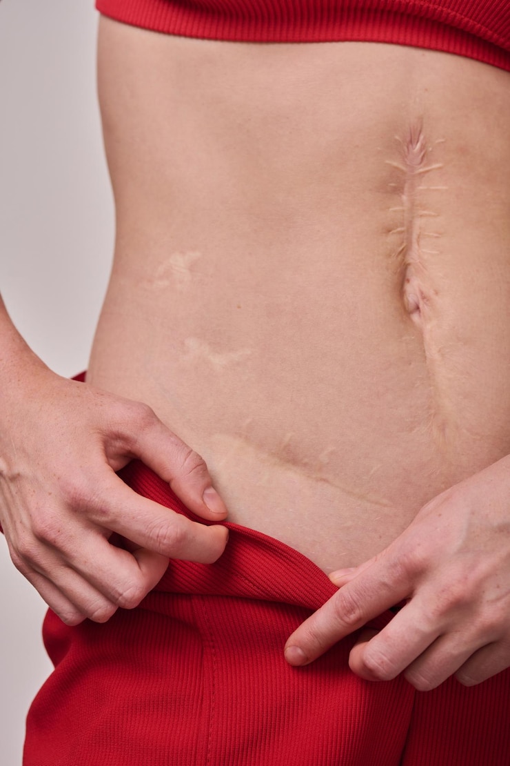 Foto mulher positiva do corpo com cicatriz no corpo