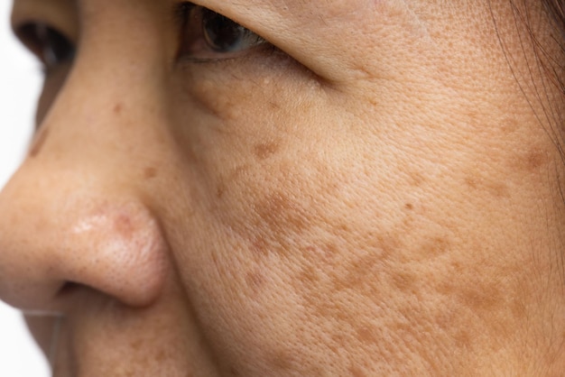 Foto mulheres na menopausa se preocupam com melasma no rosto