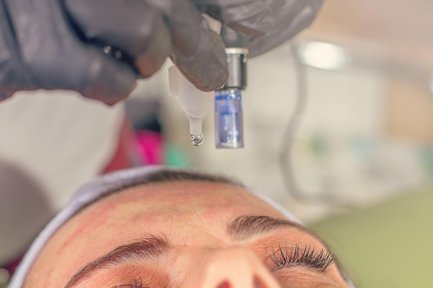 Nadel-Mesotherapie-Behandlung auf dem Gesicht einer Frau.