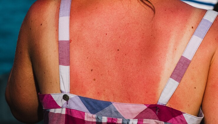 Foto nahaufnahme auf burnet-haut durch die sonne auf der frau