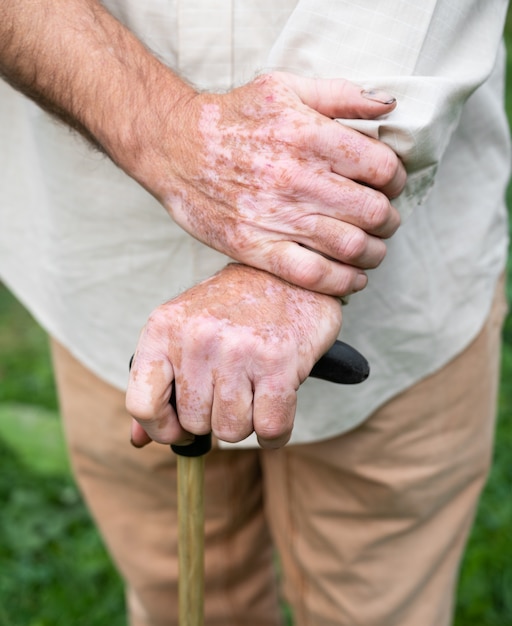 Nahaufnahme der männlichen Hände mit Vitiligo-Pigmenten im Freien