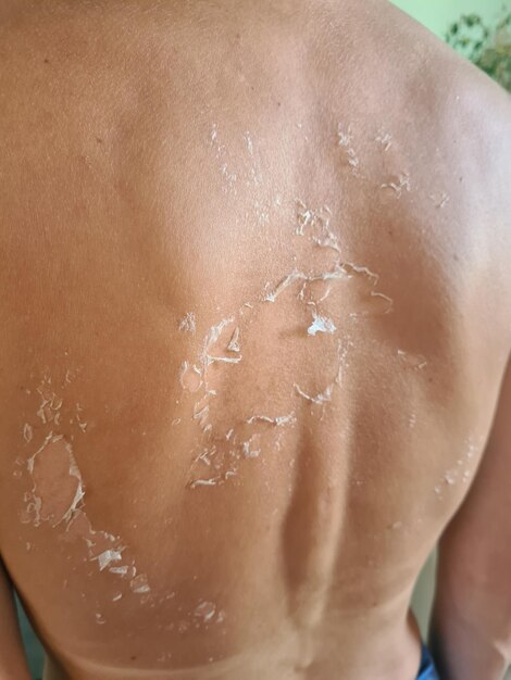 Nahaufnahme der Peeling-Haut nach Sonnenbrand im Sommer auf dem Rücken