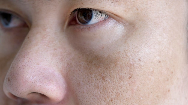 Nahaufnahme des asiatischen Mannes Gesicht mit Sommersprossen dunkle Flecken aus UV-Licht Hautpflege und Gesundheitsproblem Konzept