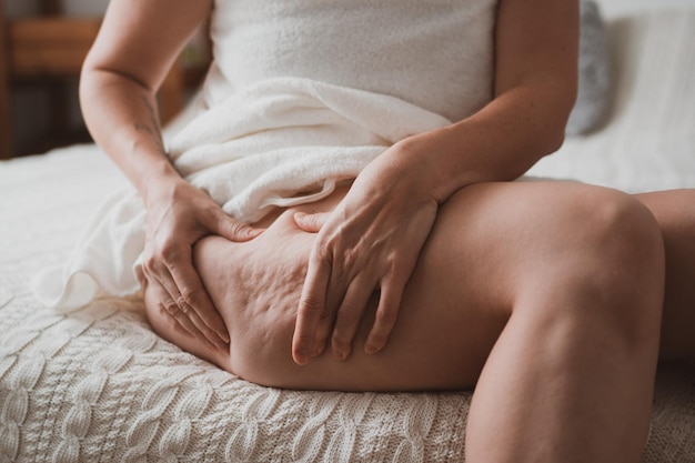 Nahaufnahme des weiblichen Körpers mit Cellulite Frau macht Massage gegen Cellulite mit ihren Händen