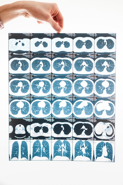 Nahaufnahme einer männlichen Hand mit Lungentomographieergebnissen