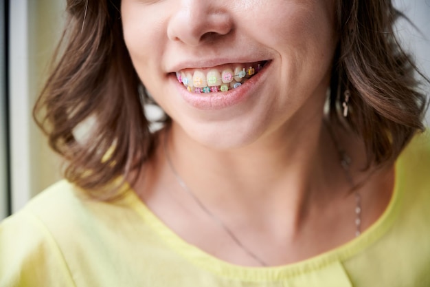 Nahaufnahme einer Patientin, die lächelt und Klammern mit bunten Gummibändern zeigt. Frau demonstriert kabelgebundene Zahnspangen mit bunten Zahnringen. Konzept der Zahnmedizin, Kieferorthopädie und Stomatologie