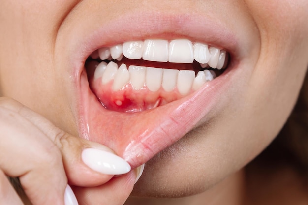 Nahaufnahme einer ulzerativen Stomatitis am Zahnfleisch. Zahnfleischentzündung. Junge Frau mit rotem Zahnfleisch
