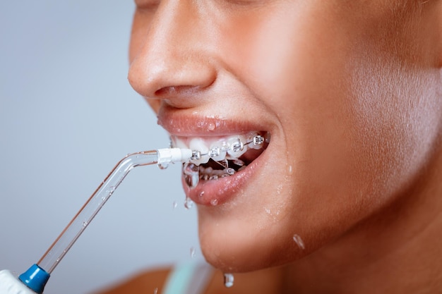 Nahaufnahme eines lächelnden Frauengesichtes mit Klammern, die ihre Zähne mit einer Munddusche reinigen.