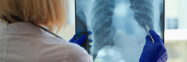 Foto nahaufnahme eines pneumologen, der sich die röntgenaufnahme der lunge ansieht. radiologe führt diagnosen durch