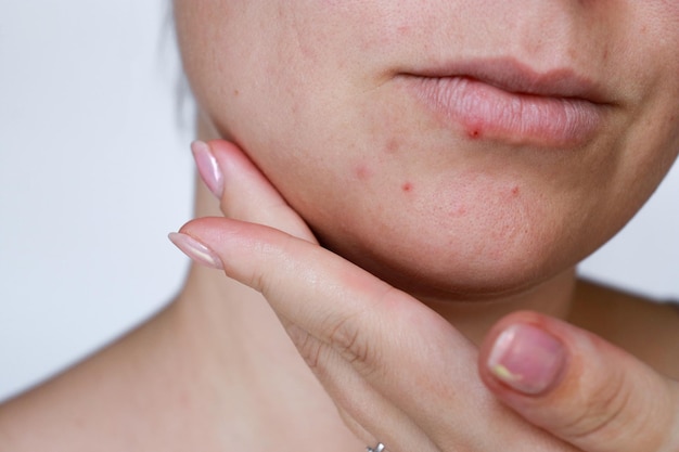 Nahaufnahme natürliche Frau schlechte Aknehaut mit Narben