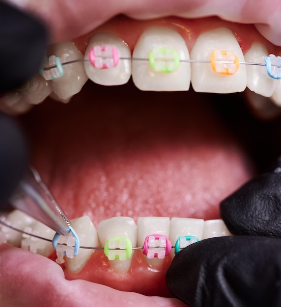 Nahaufnahme von Arzthänden, die mehrfarbige elastische Gummibänder auf die Zahnstangen des Patienten legen. Person mit drahtgebundenen Zahnstängen, die in einer Zahnklinik orthodontische Behandlung erhält. Konzept der Zahnmedizin