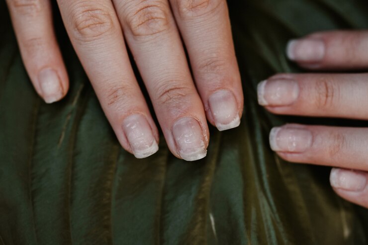 Nahaufnahme von Frauennägeln nach schlechter Maniküre. Nagel- und Nagelhautproblemkonzept.