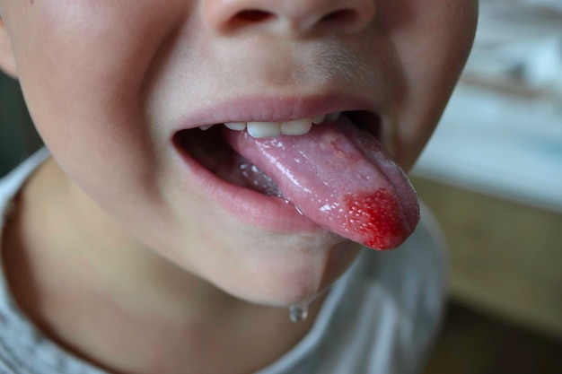 Nahaufnahme von Lippen Zunge Vorsprung von Blut Kinder gebissene Zunge hochwertiges Foto