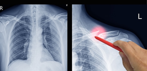 Nahaufnahme von Röntgenschulter- und Schlüsselbeinbruchschmerzen bei einem Mann, Arzt, der einen roten Stift hält, Symptome medizinisches Gesundheitskonzept.