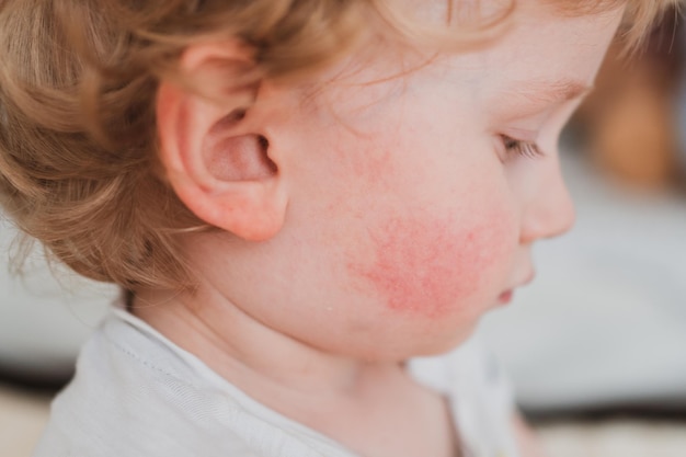 Nahrungsmittelallergie bei einem kleinen Kind auf den Wangen