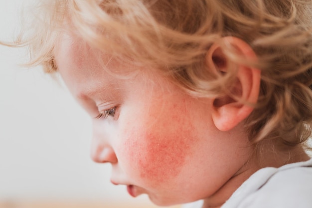 Nahrungsmittelallergie bei einem kleinen Kind auf den Wangen