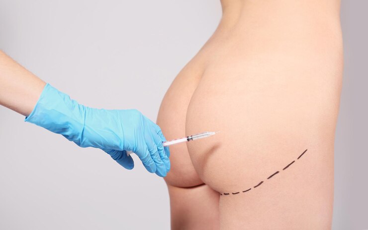 Foto las nalgas femeninas marcadas para la operación plástica y la mano de los médicos con la jeringa en un primer plano de fondo claro