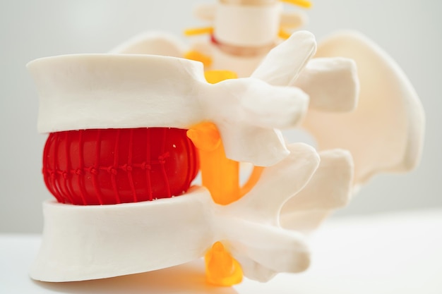 Nervio espinal y hueso Columna lumbar desplazada Fragmento de disco herniado Modelo para tratamiento médico