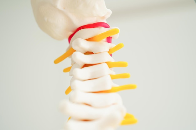 Nervio espinal y hueso columna lumbar desplazado fragmento de disco herniado Modelo para tratamiento médico