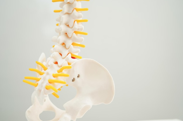 Nervio espinal y hueso columna lumbar desplazado fragmento de disco herniado Modelo para tratamiento médico