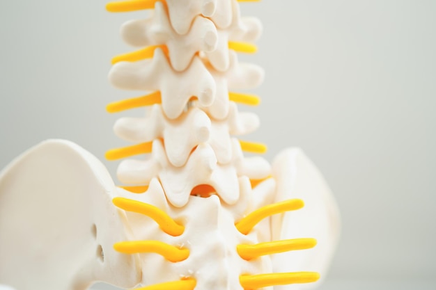 Nervio espinal y hueso columna lumbar desplazado fragmento de disco herniado Modelo para tratamiento médico