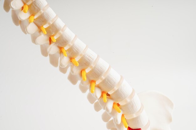 Nervio espinal y hueso columna lumbar desplazado fragmento de disco herniado Modelo para tratamiento médico