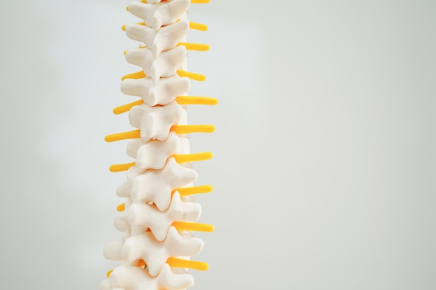 Nervio espinal y hueso Columna lumbar fragmento de hernia de disco desplazado Modelo para tratamiento médico en el departamento de ortopedia