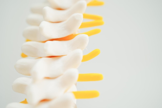 Nervio espinal y hueso Columna lumbar fragmento de hernia de disco desplazado Modelo para tratamiento médico en el departamento de ortopedia