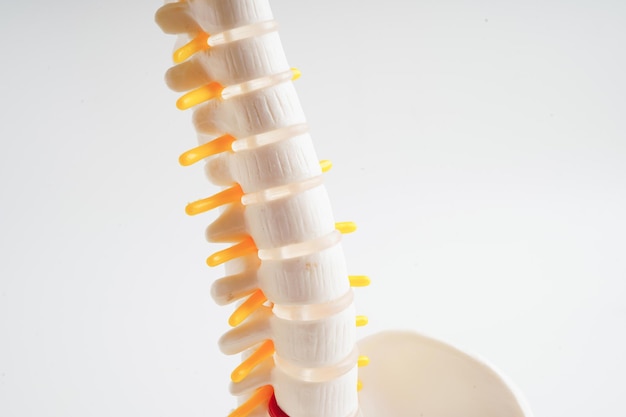 Nervo espinhal e osso Coluna lombar deslocada fragmento de disco herniado Modelo para tratamento médico