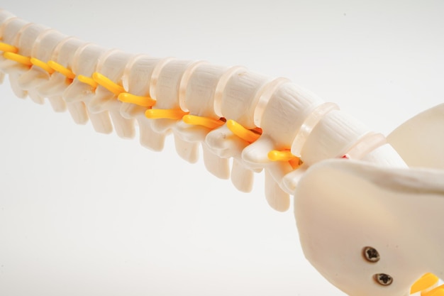 Nervo espinhal e osso Coluna lombar fragmento de disco herniado deslocado Modelo para tratamento médico
