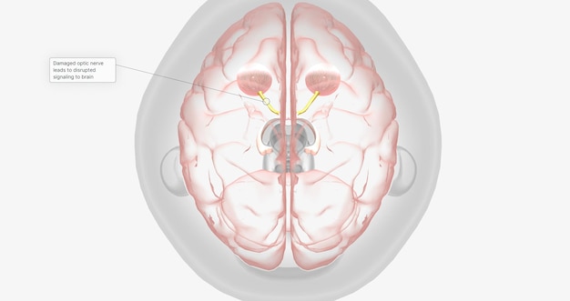 Nervo óptico danificado leva a sinalização interrompida para o cérebro