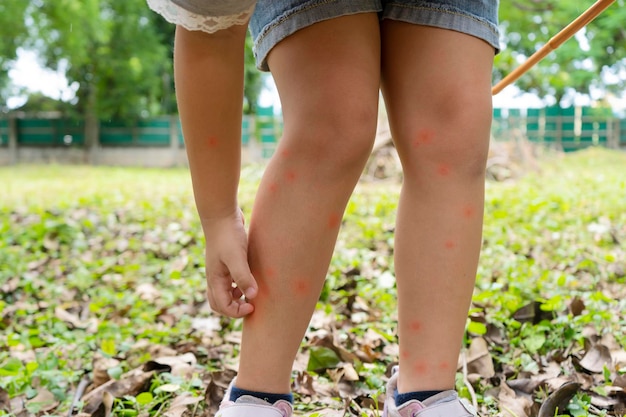 Foto niña asiática tiene alergias con picadura de mosquitos y picazón en la pierna cría de sangre de mosquitos en niños virus del dengue repelente fiebre amarilla enfermedades de la malaria del nilo occidental propagadas por el concepto de mosquitos